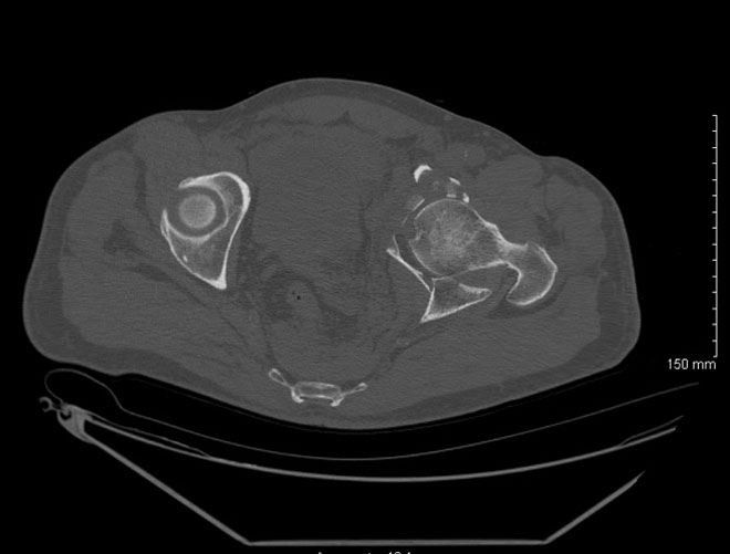 Sequela of an acetabular fracture: Images the day of the trauma
