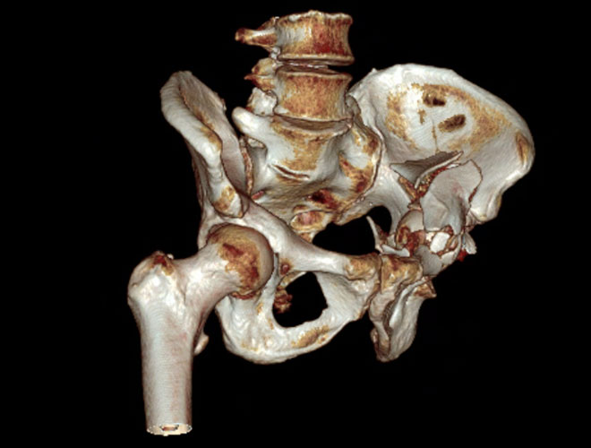Sequela of an acetabular fracture: Images the day of the trauma