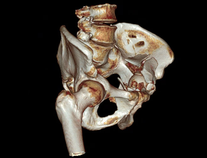 Sequela of an acetabular fracture: Images the day of the trauma