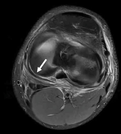 MRI axial view - White arrow: ramplesion