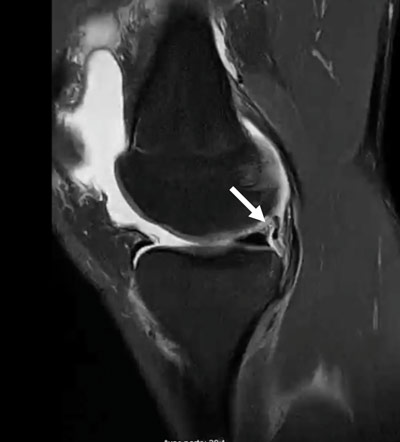 MRI sagital view - White arrow: ramplesion