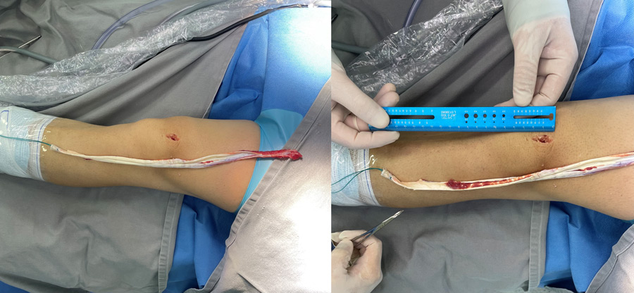 ACL graft failure done by Harmstrings: the rectus femoris tendon