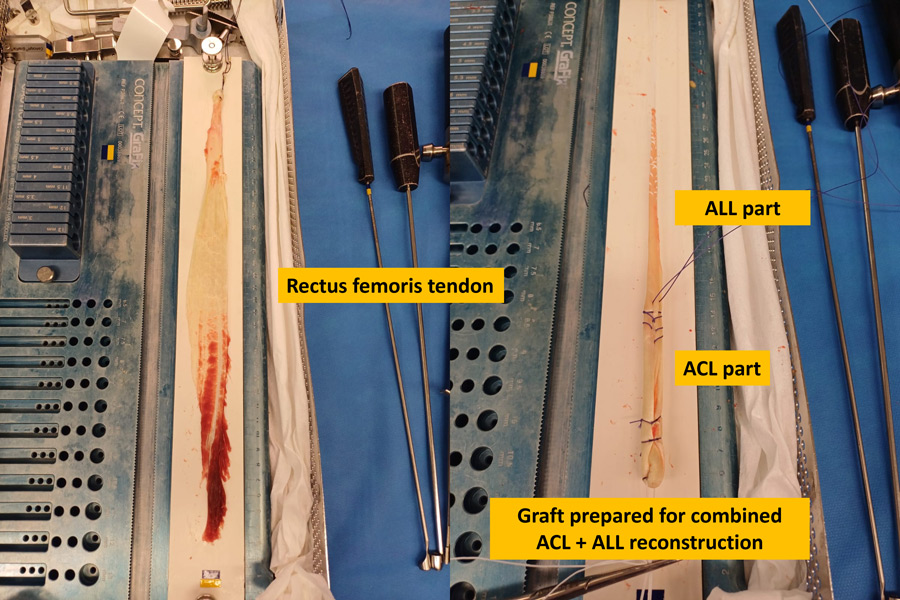 ACL graft failure done by Harmstrings: Graft prepared for combined ACL + ALL reconstruction