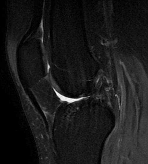 ACL graft failure done by Harmstrings: MRI showing a discontinued ACL graft