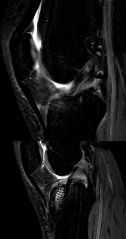 ACL graft failure done by Harmstrings: MRI showing a continous graft 5 years ago