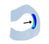 Radial tear: Stress concentrates at the inner-circumference