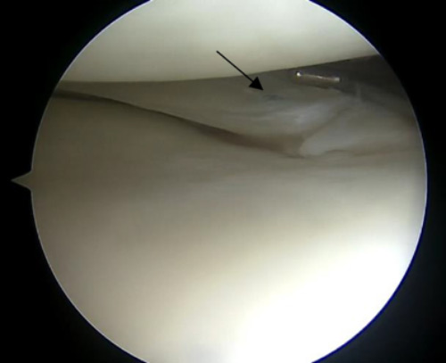 Radial tear: lateral meniscus radial tears