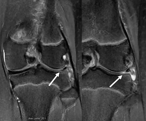 Radial tear: Radial tear of the lateral meniscus, evidenced by the “absent bow-tie sign”.