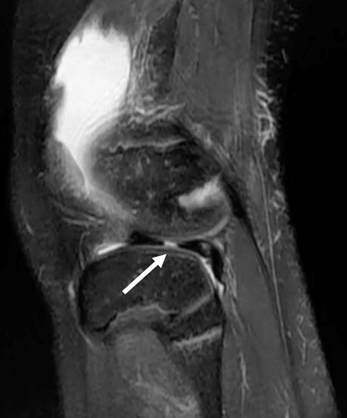 Radial tear: White arrow: Radial defect (cleft sign) indicating a radial tear of the lateral meniscus.