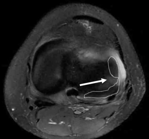 Radial tear - White arrow: Radial defect (cleft sign) indicating a radial tear of the lateral meniscus.