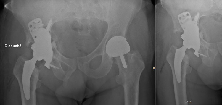Severe bone loss in a patient with hip resurfacing