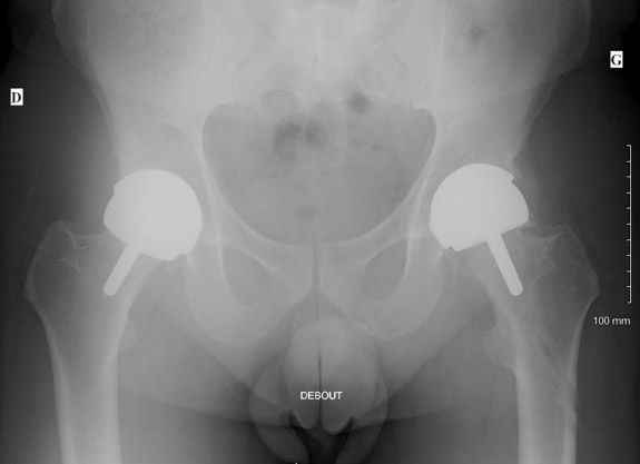 Severe bone loss in a patient with hip resurfacing: X-Ray 2012