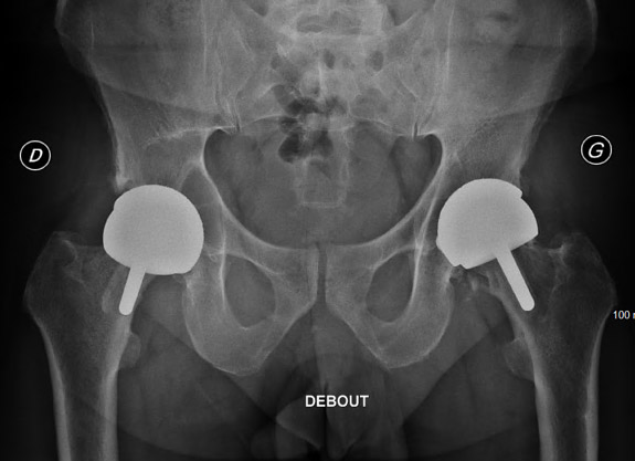 Severe bone loss in a patient with hip resurfacing: X-Ray 2024