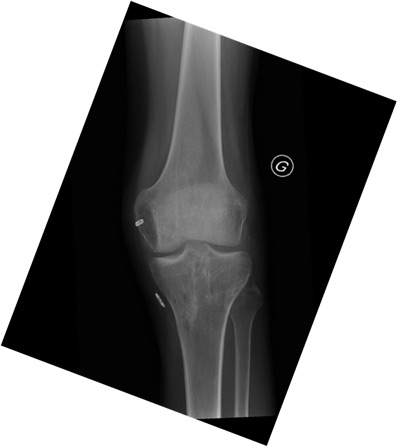 Management of a chronic multiligament knee injury: Post-op X-rays