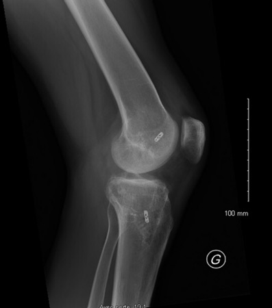 Management of a chronic multiligament knee injury: Post-op X-rays