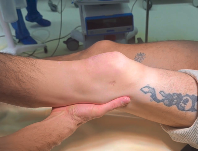 Management of a chronic multiligament knee injury: Pre-op Testing