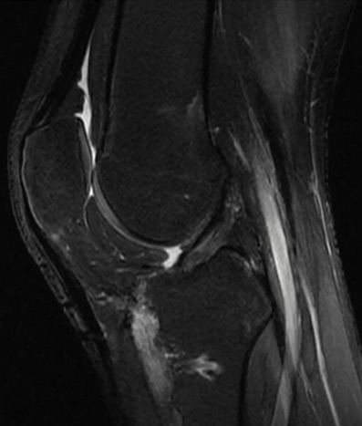Management of a chronic multiligament knee injury: Pre operative MRI