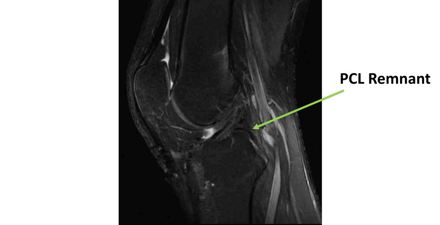 Management of a chronic multiligament knee injury: PCL Remnant 