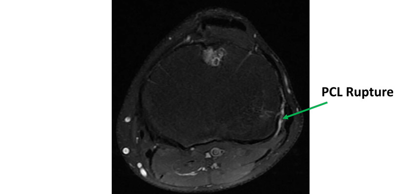 Management of a chronic multiligament knee injury: PCL Rupture
