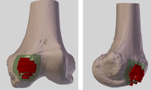 An oncologic resection using patient-specific cutting guides (3D-SIDE company) and reconstruction with allograft was performed