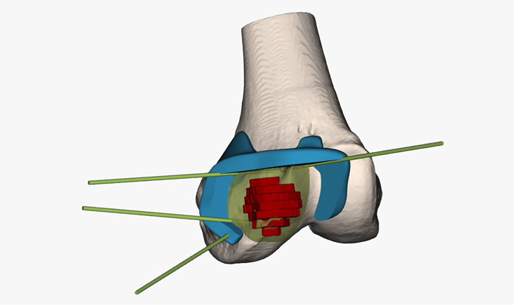 Surgical management of a subchondral cartilaginous tumor in the distal femur: resection and grafting technique