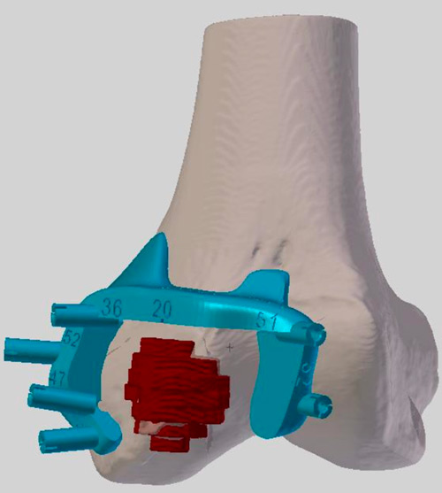 An oncologic resection using patient-specific cutting guides (3D-SIDE company) and reconstruction with allograft was performed