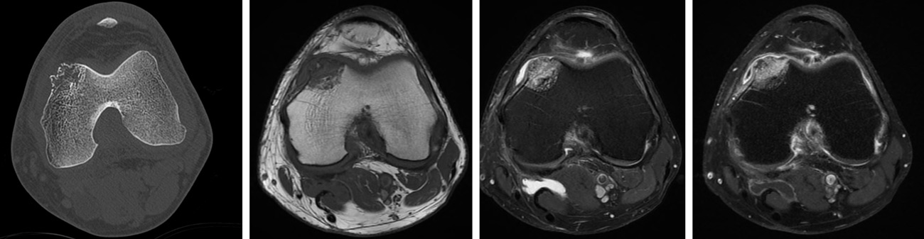 CT-scan: Subchondral osteolytic lesion of the medial femoral condyle, with cortical breach.