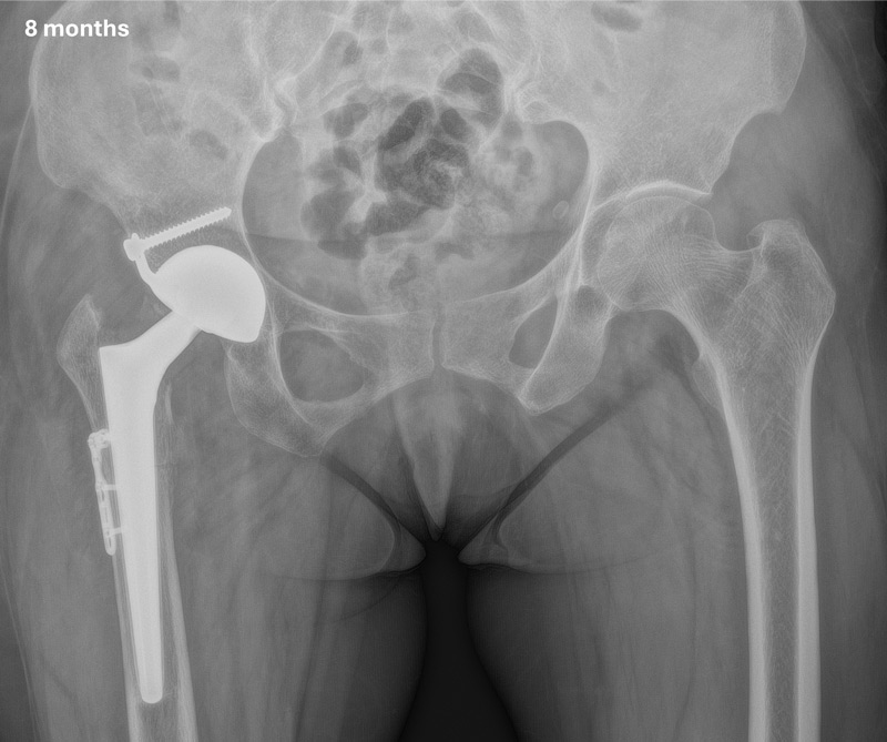 Management of a hip dysplasia in a middle-aged woman: Post-operative X-rays