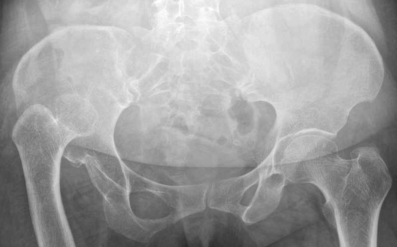 Management of a hip dysplasia in a middle-aged woman: Pre-operative X-rays and CT-scan