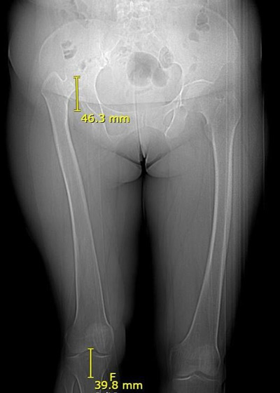 Management of a hip dysplasia in a middle-aged woman: Pre-operative X-rays and CT-scan