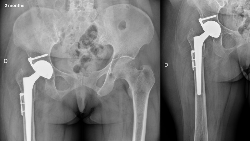 Management of a hip dysplasia in a middle-aged woman: Post-operative X-rays