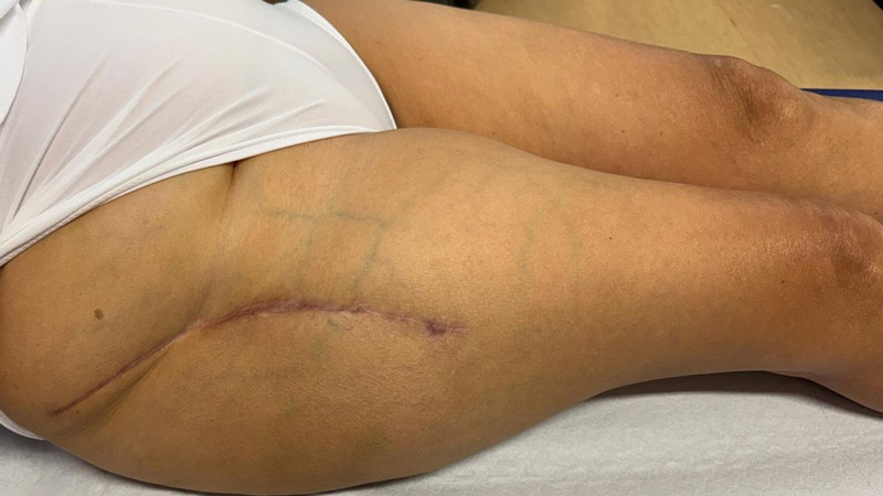 Management of a hip dysplasia in a middle-aged woman: Clinical aspect at 8 months