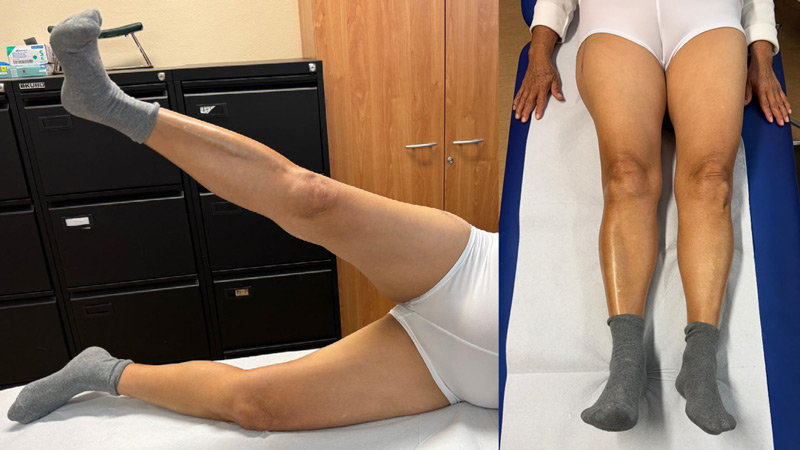 Management of a hip dysplasia in a middle-aged woman: Clinical aspect at 8 months