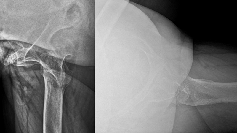 Management of a hip dysplasia in a middle-aged woman: Pre-operative X-rays and CT-scan