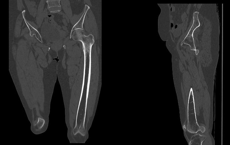 Management of a hip dysplasia in a middle-aged woman: Pre-operative X-rays and CT-scan