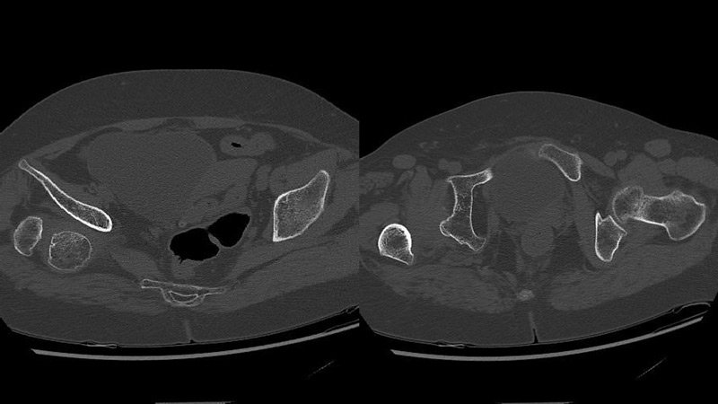 Management of a hip dysplasia in a middle-aged woman:  Pre-operative X-rays and CT-scan