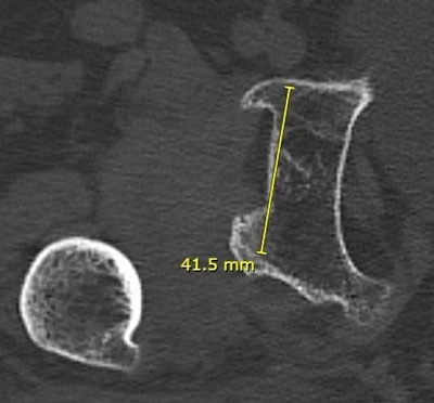 Management of a hip dysplasia in a middle-aged woman: Pre-operative X-rays and CT-scan