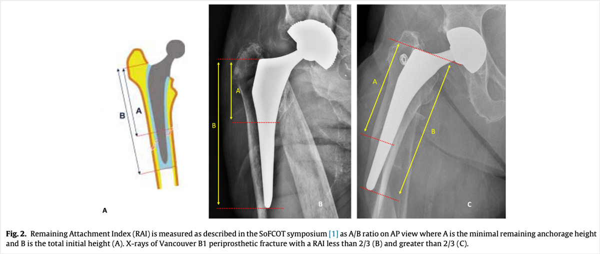 Remaining Attachment Index (RAI)