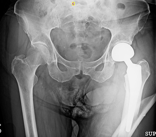 Management of a peri prostetic femoral fracture: Imagery