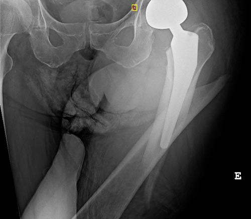 Management of a peri prostetic femoral fracture: Imagery
