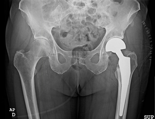 Management of a peri prostetic femoral fracture: Previous X-rays