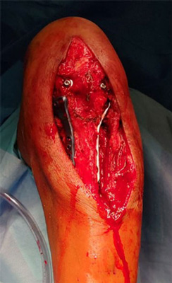 Intra-operative pictures