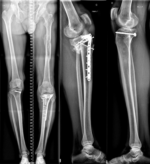 8 Months xrays Knee stable but stiff walk without crusches