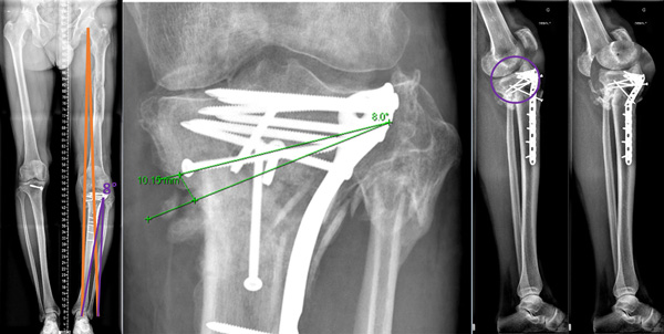 Pre-operative planning