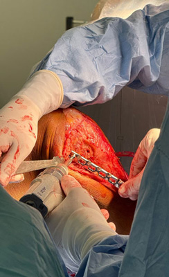 Intra-operative pictures