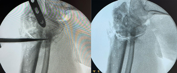 Intra-operative pictures