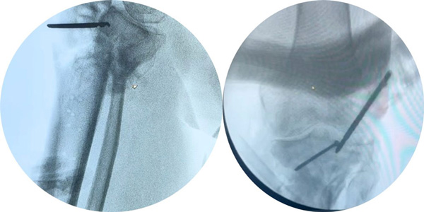 Intra-operative pictures