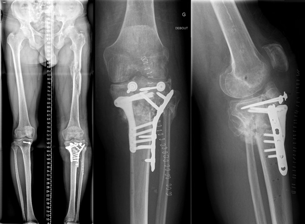 Post-operative X-Rays