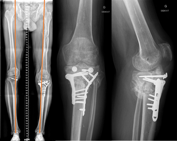 Post-operative X-Rays - 1 month