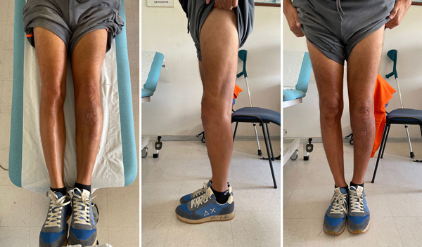 Post-operative X-Rays - 1 month